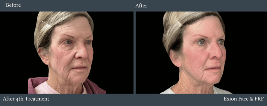 Before and after side by side pictures of a mature woman's face. On the left she appears more mature and tired. On the right, after her 4th Exion Facial RF Ultrasound treatment for acne scars in River North Chicago, her skin is smoother, glowing, and more youthful.
